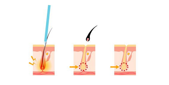 医療針脱毛について